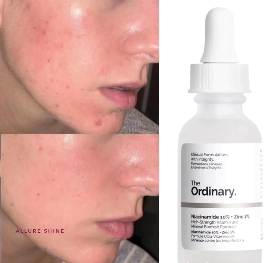 The Ordinary Niacinamide 10%+ Zinc 1% Serum 30mL - Made in Canada